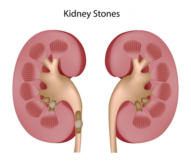 Suy thận rất nguy hiểm: Những dấu hiệu nhận biết bệnh mà ai cũng nên thuộc nằm lòng - Ảnh 2.