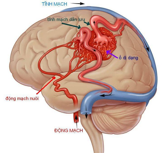 Đột ngột đau đầu, hôn mê sâu, bệnh nhân bàng hoàng phát hiện bị mắc bệnh nguy hiểm - Ảnh 2.