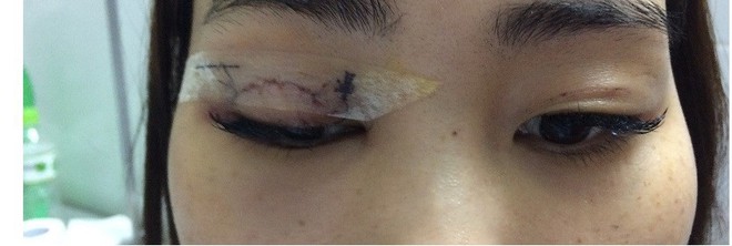 Bác sĩ BV Mắt trung ương kể chuyện vã mồ hôi phẫu thuật cho cô gái bị kim chui vào mí mắt - Ảnh 1.