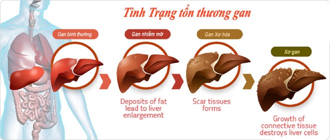 Xơ gan có thể dẫn đến ung thư gan: Đây là 4 nguyên tắc quan trọng giúp phòng ngừa hiệu quả - Ảnh 1.