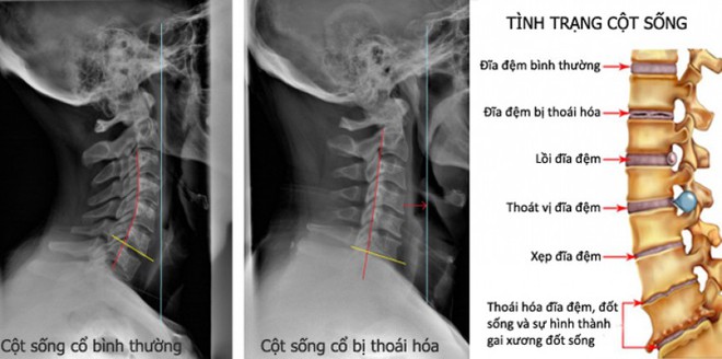 10 cấp độ thoái hóa đốt sống cổ: Hãy xem bạn bị mức mấy để xử lý trước khi bệnh nặng lên - Ảnh 2.