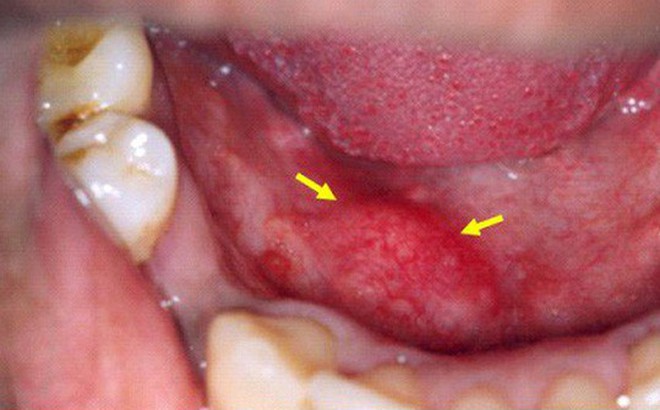 Những căn bệnh ung thư lạ lùng ít người biết