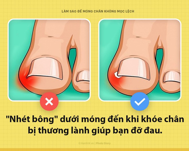 Móng chân mọc quặp đau phát khóc, mẹo nhỏ này sẽ giúp bạn thoát khỏi cơn đau - Ảnh 2.