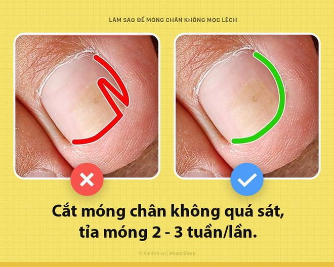 Móng chân mọc quặp đau phát khóc, mẹo nhỏ này sẽ giúp bạn thoát khỏi cơn đau - Ảnh 3.