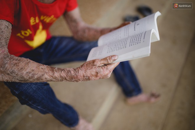 Chàng trai người cá lạc quan ở Hà Nội: Nhìn thấy bộ dạng của mình, nhiều người hỏi sao không chết đi, sống để làm gì? - Ảnh 6.