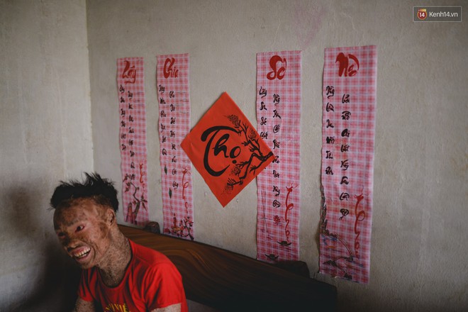 Chàng trai người cá lạc quan ở Hà Nội: Nhìn thấy bộ dạng của mình, nhiều người hỏi sao không chết đi, sống để làm gì? - Ảnh 10.