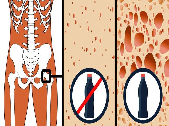 Những lý do để bạn từ bỏ việc lạm dụng nước ngọt có ga - Ảnh 2.