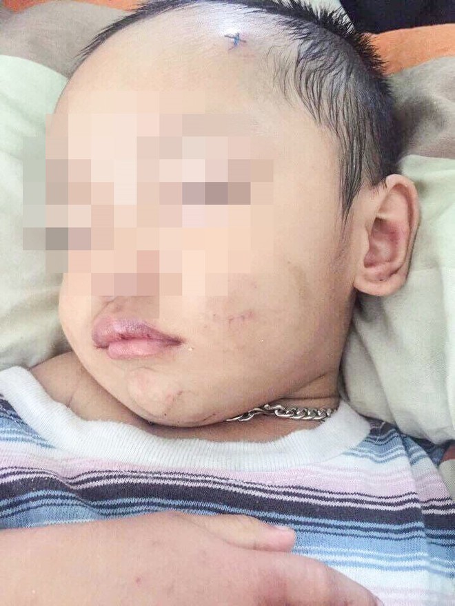 Những hình ảnh đau lòng của bé trai 3 tuổi nghi bị cha dượng bạo hành - Ảnh 2.