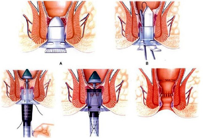 Những điều cần biết về bệnh trĩ: Lưu ý 2 việc tuyệt đối không làm - Ảnh 2.