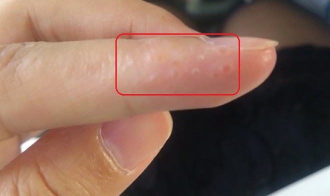 7 dấu hiệu cảnh báo bệnh nguy hiểm biểu hiện trên bàn tay của bạn - Ảnh 2.