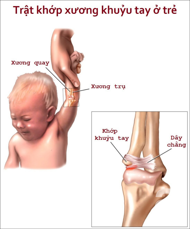 Cha mẹ còn cầm tay con theo kiểu này, đề phòng trật khớp tay con - Ảnh 4.