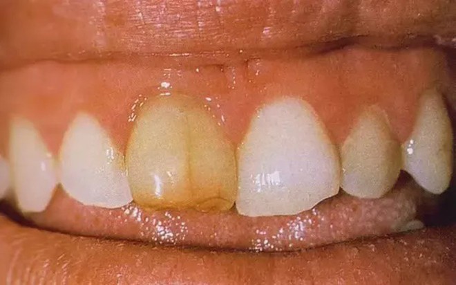 Tại sao răng của chúng ta bị ngả sang màu vàng? - Ảnh 2.