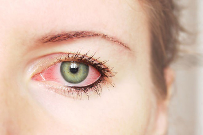 Dấu hiệu cảnh báo bệnh tật từ đôi mắt, phải đi khám ngay nếu không muốn mù lòa - Ảnh 3.