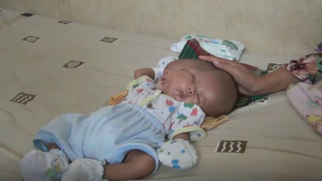 Bé trai Indonesia mắc dị tật hiếm gặp nhất: sinh ra với 2 khuôn mặt và 2 bộ não - Ảnh 1.