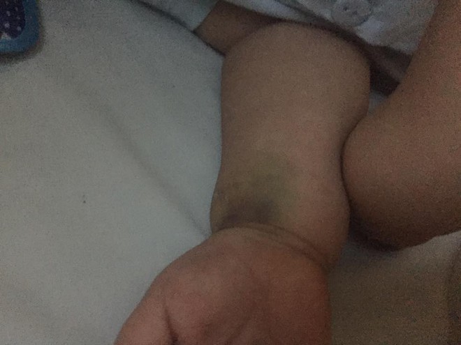 Tưởng chỉ bị đau chân bình thường, ai ngờ bé 10 tháng tuổi mắc phải căn bệnh lạ ở trẻ em - Ảnh 2.