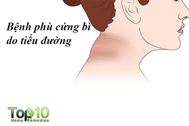 Các vấn đề về da liên quan đến bệnh tiểu đường thường gặp nhất - Ảnh 8.