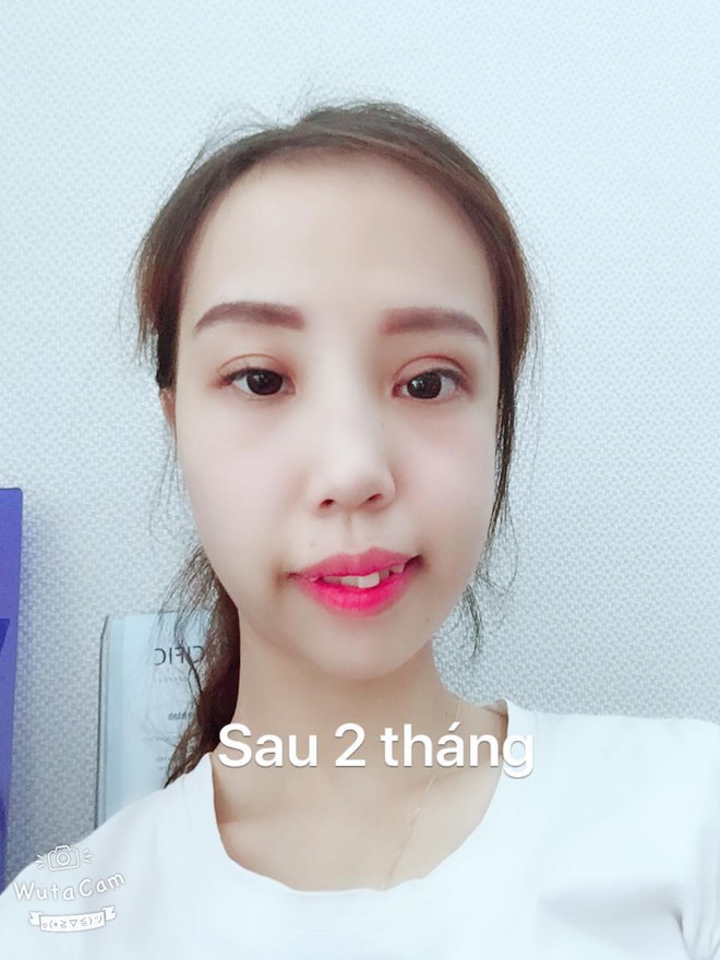 Bị bạn bè trêu chọc vì teo nửa bên mặt, cô gái Hà Nội lột xác sau phẫu thuật thẩm mỹ - Ảnh 10.