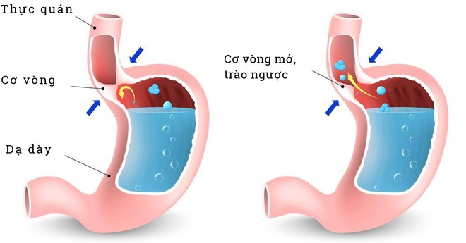 Hôi miệng chữa mãi không khỏi: Đây là 5 nguyên nhân và cách chữa chính xác bạn nên biết - Ảnh 6.