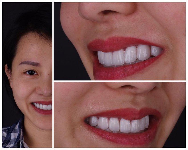 “Mê mẩn” với phương pháp bọc răng sứ tại nha khoa Kim - Ảnh 3.