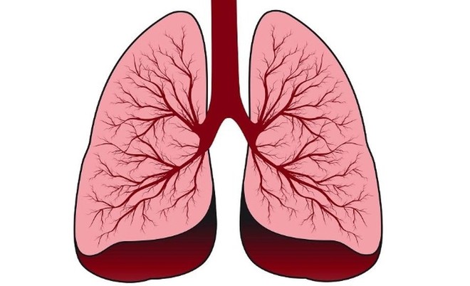 Xu hướng người trẻ tuổi mắc ung thư phổi đang tăng nhanh: Làm sao để phát hiện sớm nhất? - Ảnh 2.