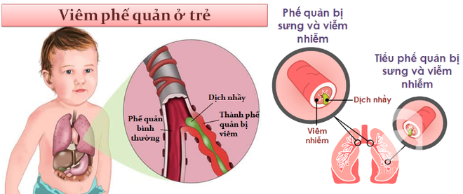 Tưởng con chỉ ho do nhiễm lạnh thông thường, mẹ không ngờ con suýt mất mạng vì căn bệnh này - Ảnh 6.