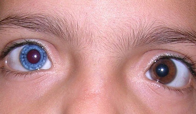 Tại sao một số người có hai màu mắt khác nhau? - Ảnh 1.