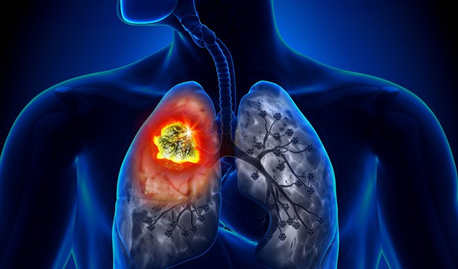 90% ca ung thư phổi là do thủ phạm này gây ra: Bỏ ngay là biện pháp phòng bệnh tốt nhất - Ảnh 1.