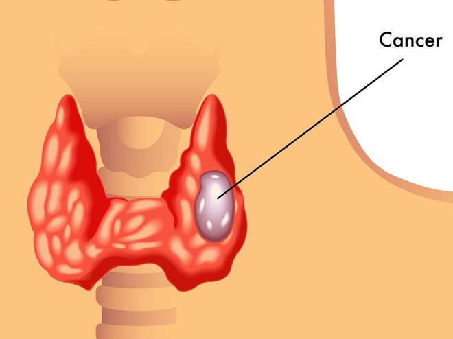 Khó nuốt khi ăn: Dấu hiệu bệnh ung thư rất nguy hiểm nhiều người thường bỏ qua - Ảnh 1.