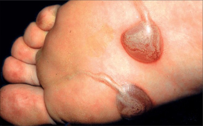 Ðề phòng giun móc chó, mèo gây bệnh nguy hiểm - Ảnh 1.