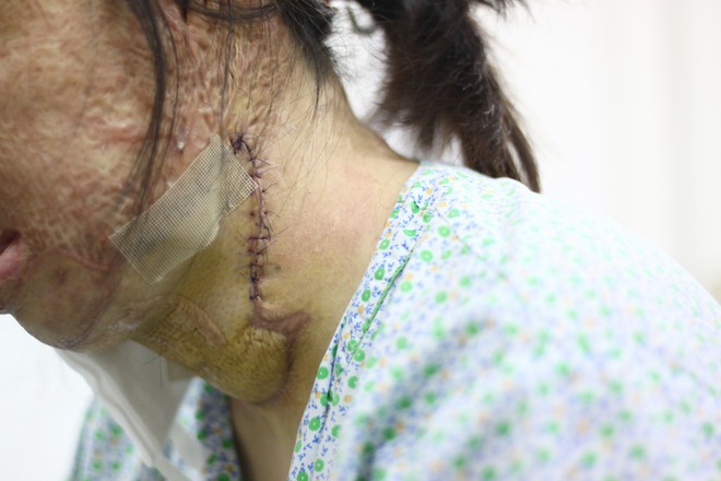 Sau 1 năm và hàng chục cuộc phẫu thuật, người vợ Hà Nội bị chồng thiêu hôm mùng 2 Tết, chỉ có 1% cơ hội sống sót đã hồi sinh - Ảnh 6.