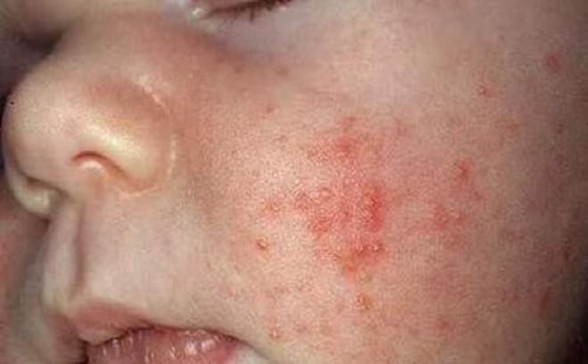 Káº¿t quáº£ hÃ¬nh áº£nh cho bá»nh viÃªm da cÆ¡ Äá»a