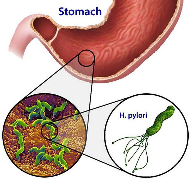 Chọn kháng sinh diệt vi khuẩn H.Pylori hiệu quả - Ảnh 1.