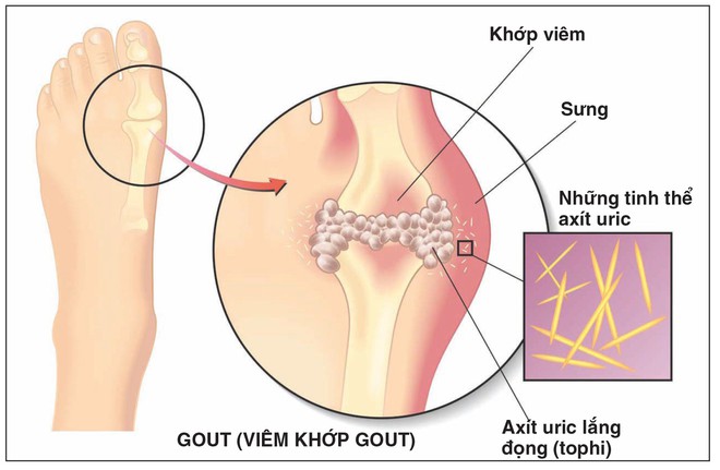 Bệnh gout ở người trẻ - chớ xem thường! - Ảnh 1.