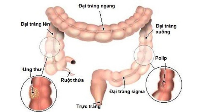 5 dấu hiệu điển hình cảnh báo khối u ung thư đại trực tràng đang phát triển thần tốc - Ảnh 3.