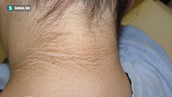 Không thể coi thường: 8 dấu hiệu trên da của bệnh đái tháo đường - Ảnh 3.