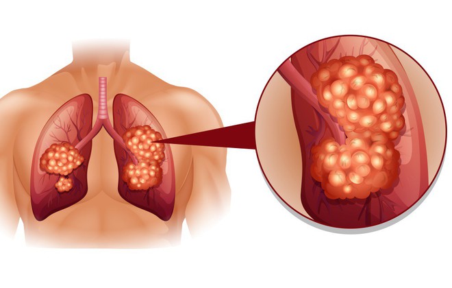 Ho trong bao lâu thì bạn nên đi khám để phòng ngừa bệnh ung thư phổi? - Ảnh 2.