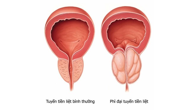 Nam giới mắc 3 căn bệnh này dễ gây rối loạn chức năng tình dục: Tuyệt đối không chủ quan - Ảnh 4.