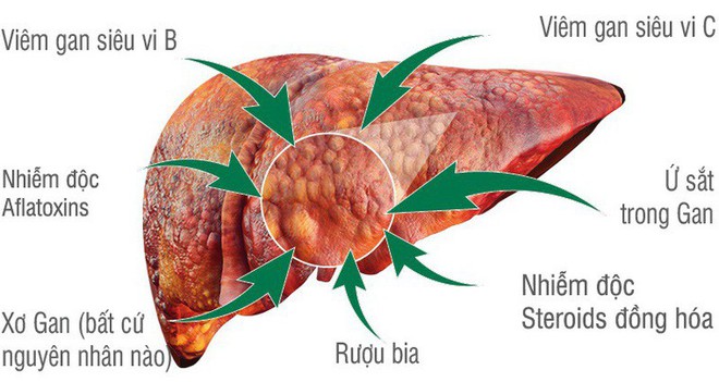 Tại sao mọi người trên thế giới đều quan tâm, thậm chí sợ hãi bệnh ung thư gan? - Ảnh 2.