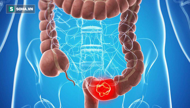 Nếu trả lời có 2 lần trở lên, bạn nên đi kiểm tra ung thư đại trực tràng ngay lập tức - Ảnh 1.