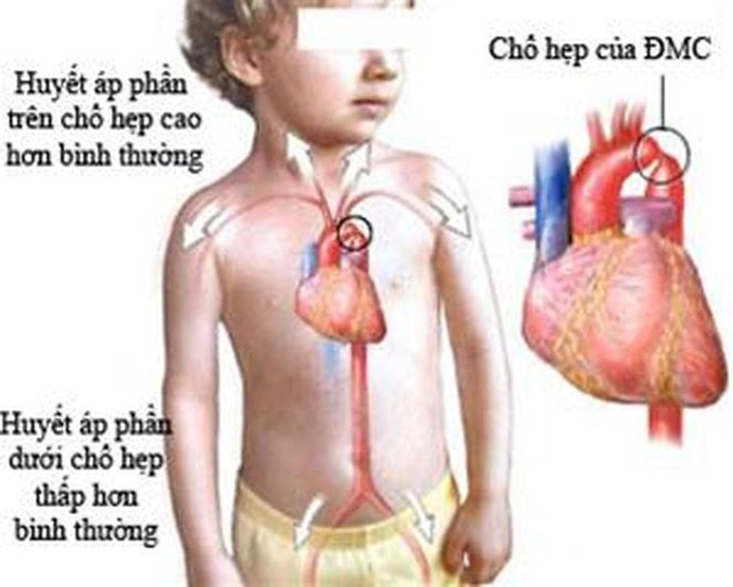 Nhận biết sớm một số bệnh tim bẩm sinh - Ảnh 1.