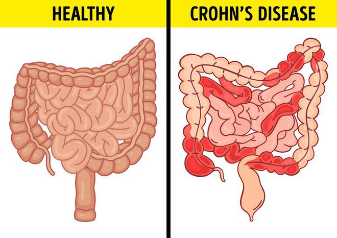 Chứng đầy hơi có thể là dấu hiệu của 6 căn bệnh nguy hiểm - Ảnh 3.