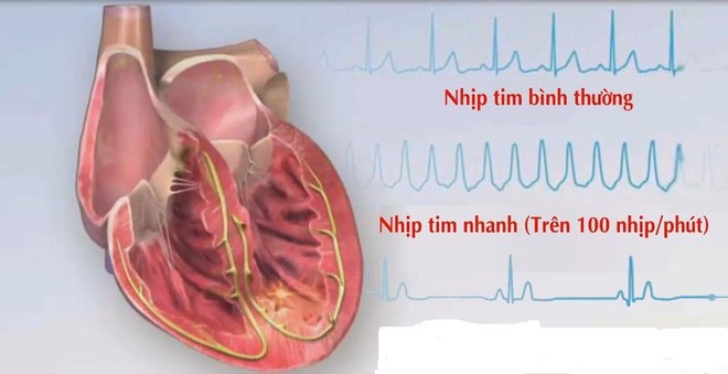 Nhận diện “thủ phạm” gây rối loạn nhịp tim - Ảnh 1.