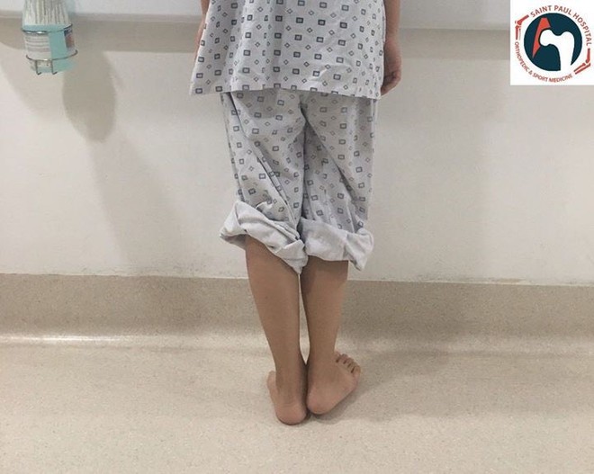 Ca bệnh hiếm: Cô bé lớp 9 chân ngắn chân dài khiến bác sĩ buộc phải thay khớp háng - Ảnh 3.