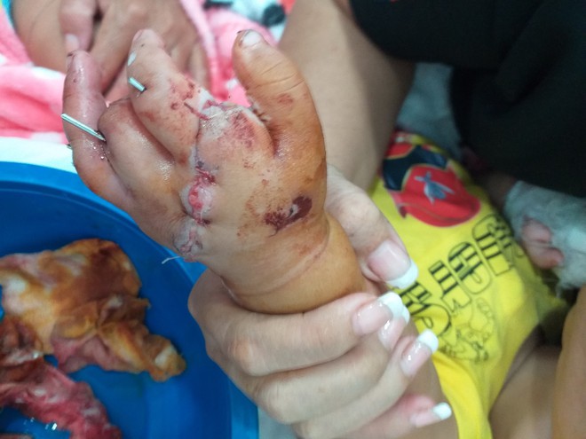 Bé 12 tháng tuổi bị xích xe nghiến đứt bàn tay - Ảnh 1.