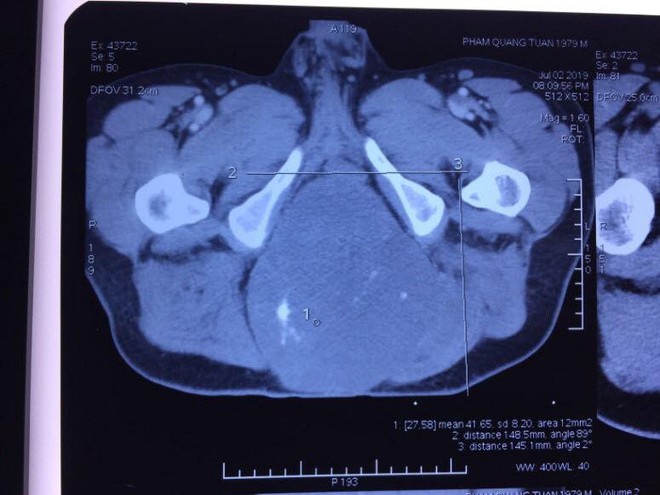 Người đàn ông không nằm, ngồi được vì đeo khối u khổng lồ đằng sau mông - Ảnh 2.