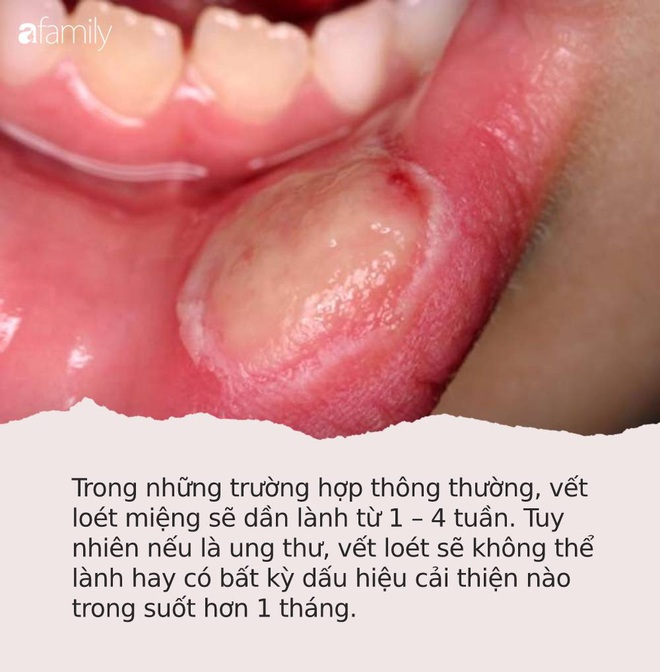 Đừng coi thường 4 dấu hiệu này khi loét miệng bởi có thể đó là bằng chứng cảnh báo ung thư đang phát triển trong cơ thể bạn - Ảnh 1.