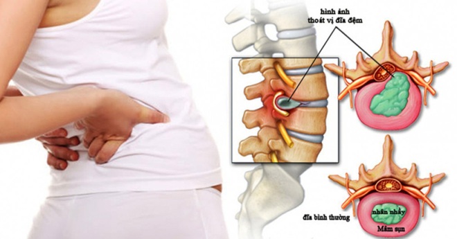 TS. BS Võ Xuân Sơn: Thoát vị đĩa đệm có thực sự đáng sợ? - Ảnh 2.