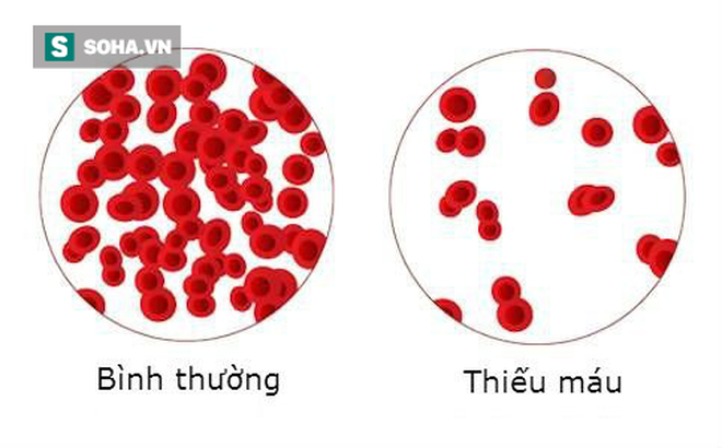 Thiếu máu rất nguy hiểm: TS dinh dưỡng hướng dẫn 5 tuyệt chiêu bổ máu hiệu quả nhất - Ảnh 2.