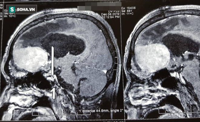 Người đàn ông thoát cảnh điên dại sau nhiều năm, thủ phạm phát bệnh ít ai ngờ tới - Ảnh 1.