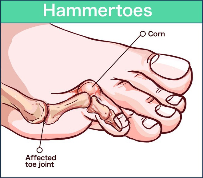 Ngoài bàn chân, 3 bộ phận cơ thể này cũng tổn thương vì giày cao gót - Ảnh 5.